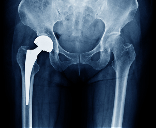 Total Hip Replacement