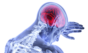Multiple Sclerosis