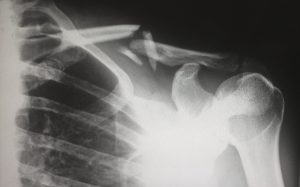 osteoporosis