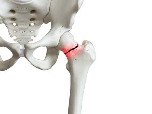Femur Neck Fracture Broken Hip