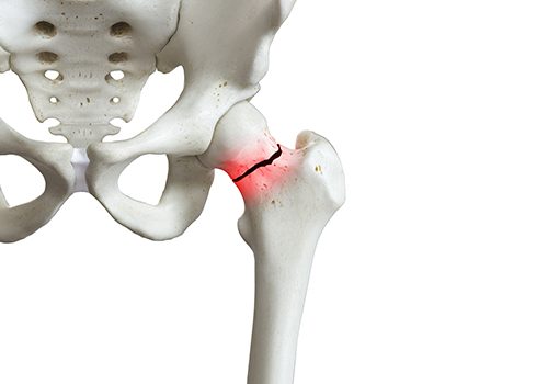Femur Neck Fracture Broken Hip