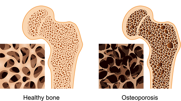 Osteoporosis